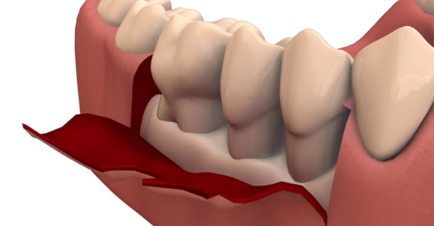 Flap Surgery